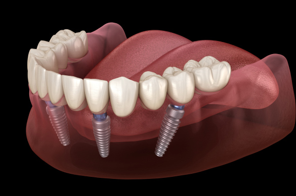 Zobni implantati All on 4, prikazani v čeljusti, prikaz delovanja celotne zobne proteze