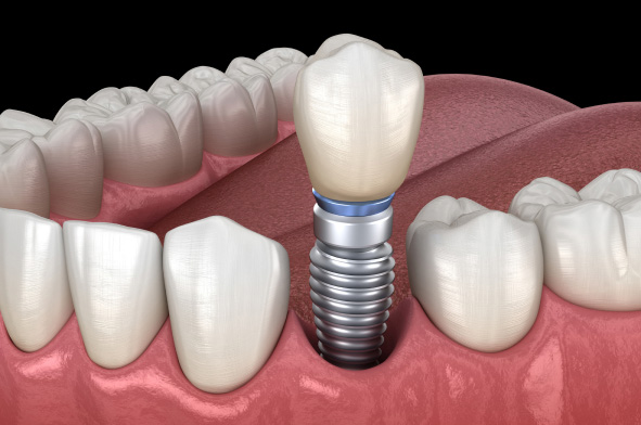 Zobni implantat prikazan v čeljusti, prikaz delovanja zobnega vsadka